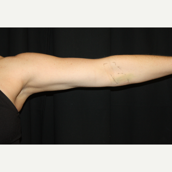 35-44 year old woman treated with CoolSculpting after 2033536