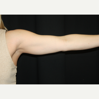 35-44 year old woman treated with CoolSculpting before 2033536