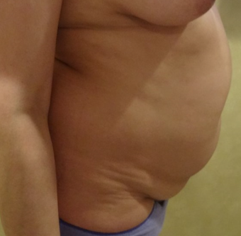 35-44 year old woman treated with Liposculpture before 3749255