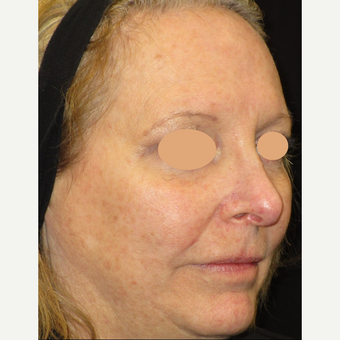 55-64 year old woman treated with Laser Treatment after 3122433