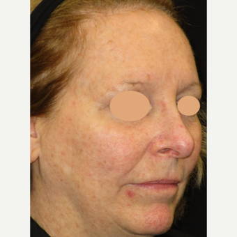55-64 year old woman treated with Laser Treatment before 3122433