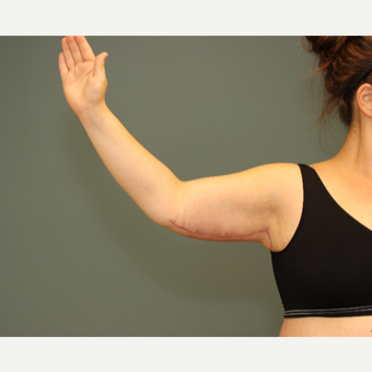 25-34 year old woman treated with Arm Lift after 3630255