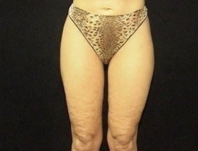 Thighplasty/Body Lift after 1092857