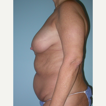 55-64 year old woman treated with Mommy Makeover before 3375441