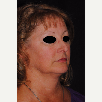 Autologous Fat Transfer and Precision TX to lower third of face before 3433731