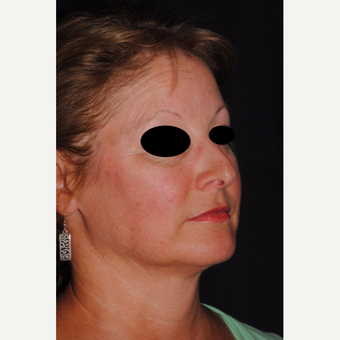 Autologous Fat Transfer and Precision TX to lower third of face after 3433731