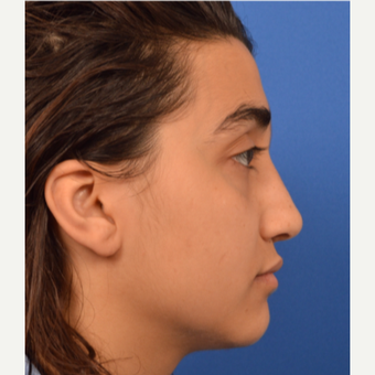 18-24 year old woman treated with Rhinoplasty after 3220448
