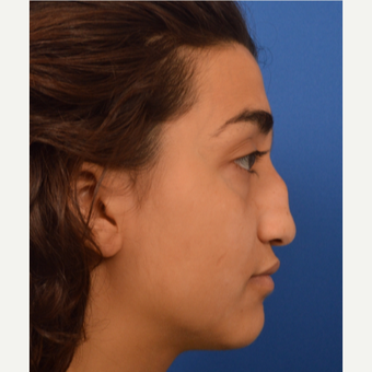 18-24 year old woman treated with Rhinoplasty before 3220448