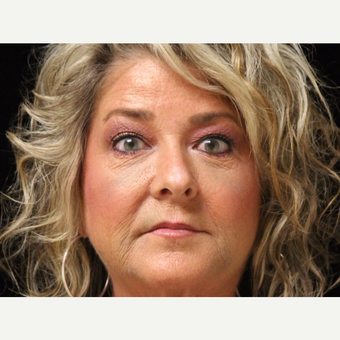 55-64 year old woman treated with Liquid Facelift after 3502684