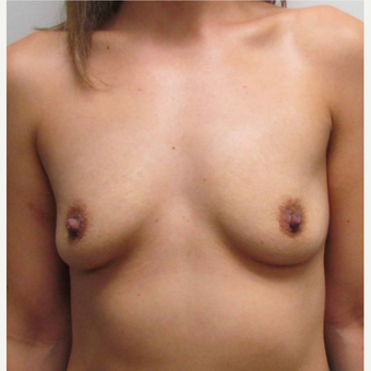 Breast Implants for this 31 Year Old Hispanic Woman before 3006163