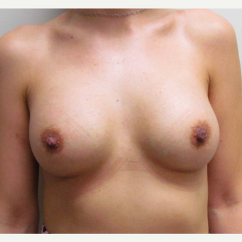 Breast Implants for this 31 Year Old Hispanic Woman after 3006163