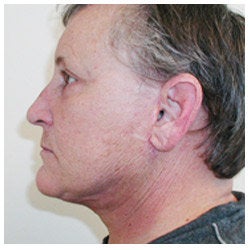 Upper and lower eyelid surgery, face lift, neck lift, and brow lift. 334402