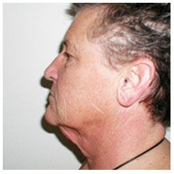 Upper and lower eyelid surgery, face lift, neck lift, and brow lift. 334402
