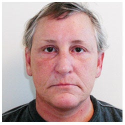 Upper and lower eyelid surgery, face lift, neck lift, and brow lift. after 334402