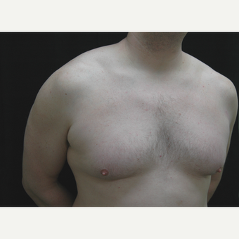 35-44 year old man treated with Male Breast Reduction before 3181914