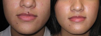 Mole removal using plastic surgery techniques before 718230