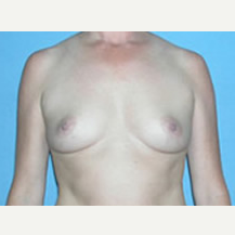 35-44 year old woman treated with Breast Augmentation before 3781216