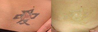Tattoo Removal using PicoSure before 1248288