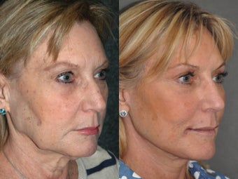 Liquid Non Surgical Rhinoplasty Nosejob with Perlane Filler after 1521372