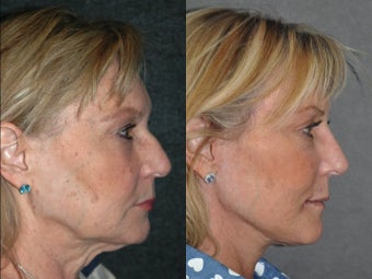 Liquid Non Surgical Rhinoplasty Nosejob with Perlane Filler before 1521372
