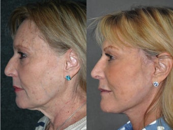 Liquid Non Surgical Rhinoplasty Nosejob with Perlane Filler 1521372