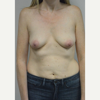 35-44 year old woman treated with Breast Augmentation before 3303490