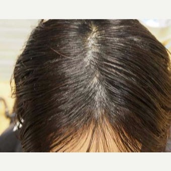 45-54 year old woman treated with Hair Loss Treatment Scalp MicroPigmentation (SMP) for Long Hair after 1958912