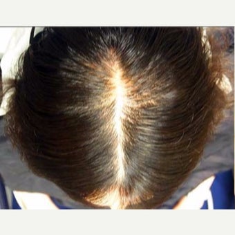 45-54 year old woman treated with Hair Loss Treatment Scalp MicroPigmentation (SMP) for Long Hair before 1958912