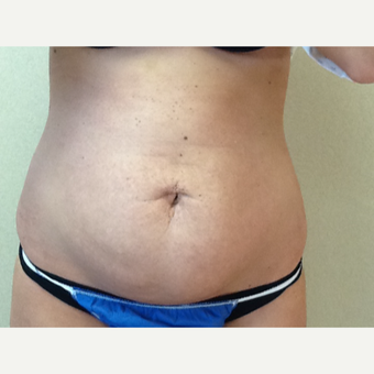 25-34 year old woman treated with Profound RF after 3530837