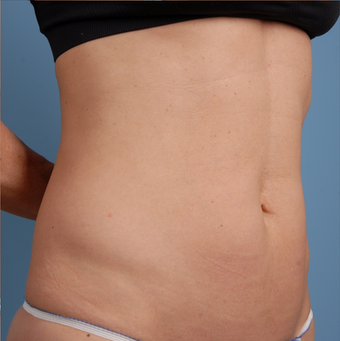 TruSculpt after 894714
