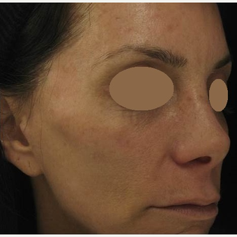 45-54 year old woman treated with IPL before 3153385