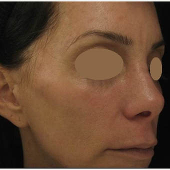 45-54 year old woman treated with IPL after 3153385