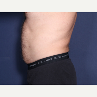 45-54 year old man treated with Liposculpture (view 2 of 2) after 3709695