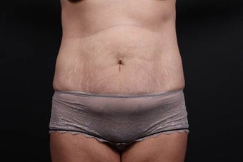 This patient underwent a full tummy tuck before 1052399