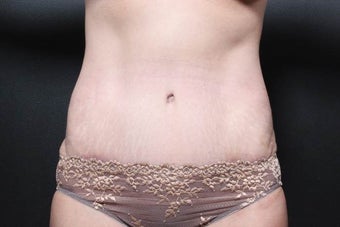 This patient underwent a full tummy tuck after 1052399