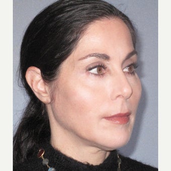 45-54 year old woman treated with Voluma after 2443665