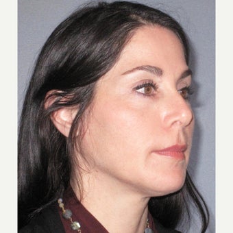 45-54 year old woman treated with Voluma before 2443665