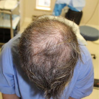 50 year old man treated with Scars Treatment before 3615222
