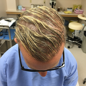 50 year old man treated with Scars Treatment after 3615222