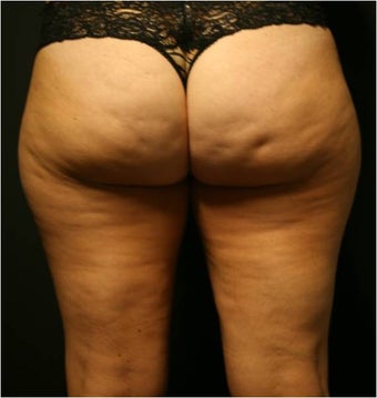 SmartLipo MPX before 686139