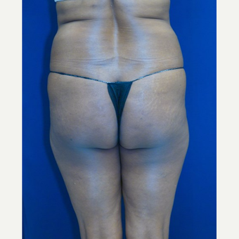 55-64 year old woman treated with Brazilian Butt Lift before 3109943