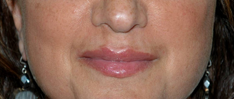 Non-surgical Lip Augmentation for Improved Contour and Definition after 896476
