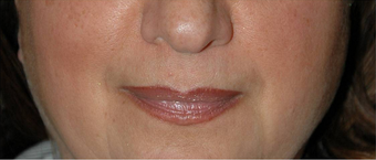 Non-surgical Lip Augmentation for Improved Contour and Definition before 896476