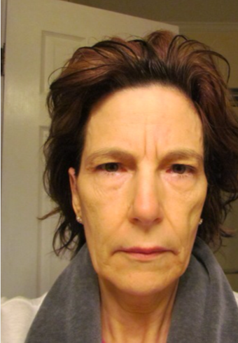 55-64 year old woman treated with Fat Transfer & Eyelid Lift before 2833899