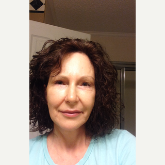 55-64 year old woman treated with Fat Transfer & Eyelid Lift after 2833899