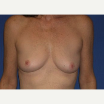 55-64 year old woman treated with Breast Augmentation before 3220028