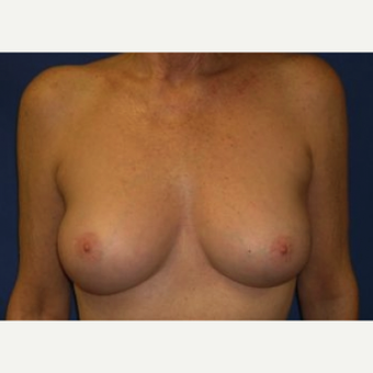 55-64 year old woman treated with Breast Augmentation after 3220028