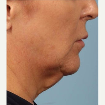 55-64 year old woman treated with Kybella before 2075875