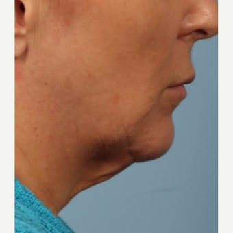 55-64 year old woman treated with Kybella after 2075875