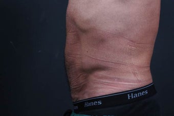 Athletic male who benefited from endoscopic lower abdominal wall tightening. after 659800
